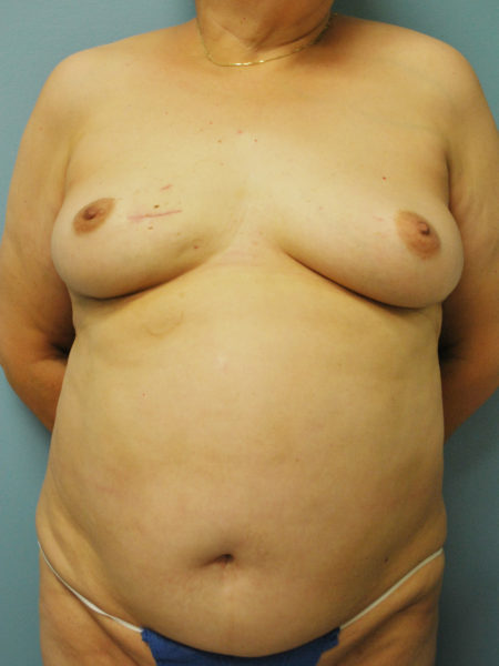 Direct to Implant Reconstruction Patient 06 - Before 