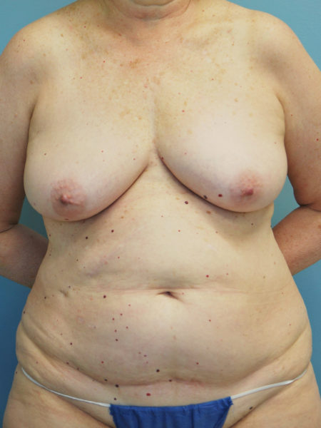 Direct to Implant Reconstruction Patient 02 - Before 