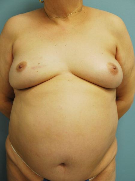 Direct to Implant Reconstruction Patient 06 - After 