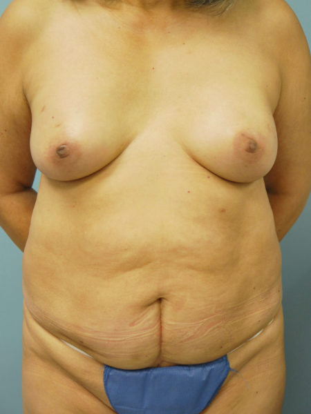 Direct to Implant Reconstruction Patient 04 - After 