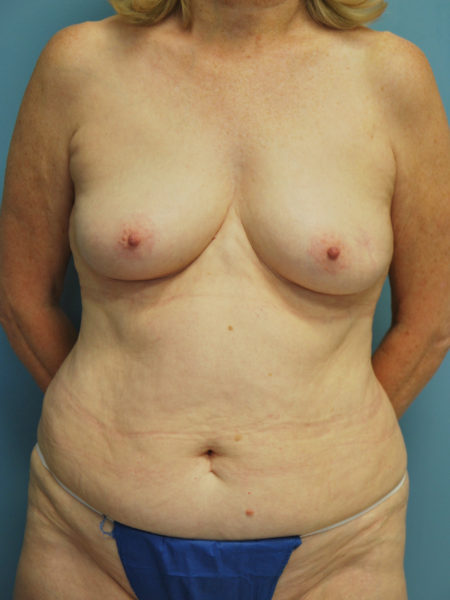 Diep Flap Patient 05 - Before 