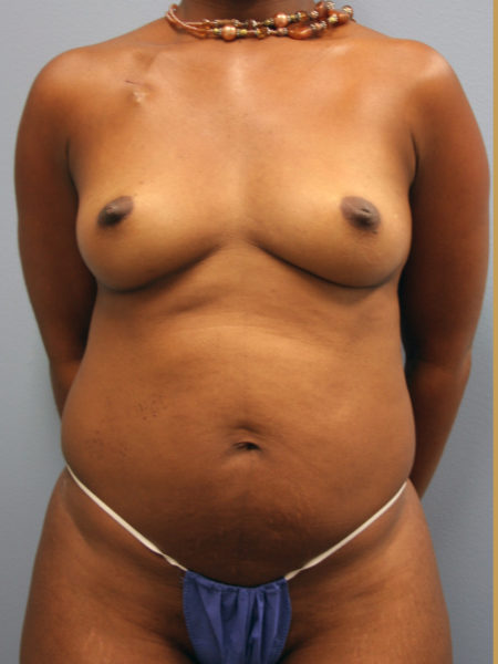 Diep Flap Patient 08 - Before 