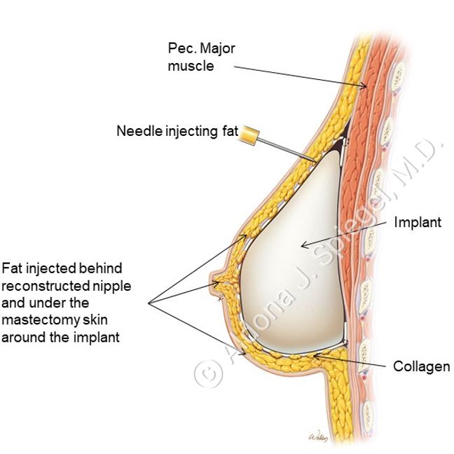 What Is Fat Grafting?