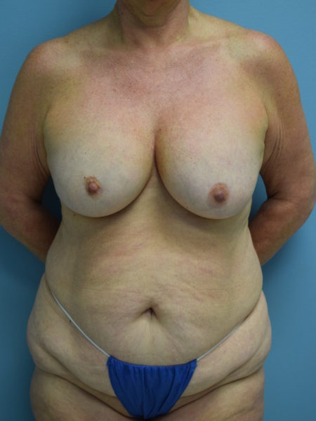 Direct to Implant Patient 42 - Before 