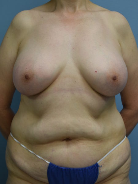 Breast Augmentation Patient 02 - After 