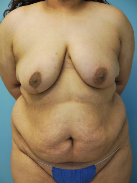 Breast Asymmetry Patient 01 - After 
