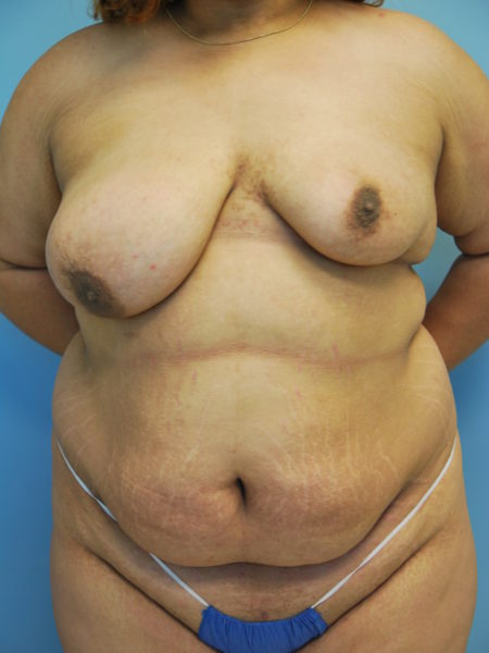 Breast Asymmetry Patient 01 - Before 