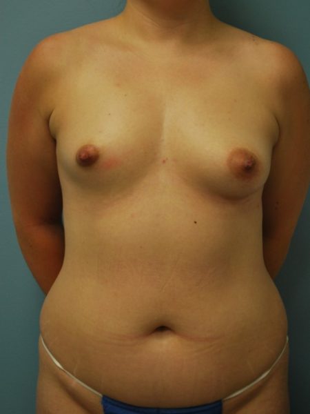 Breast Asymmetry Correction Patient 02 - Before 