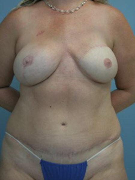 Unilateral Immediate Diep Flap Patient 11 - After 