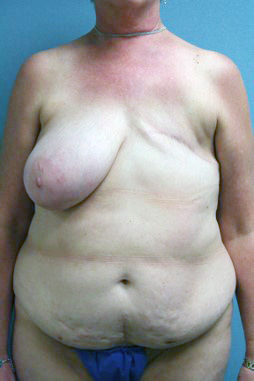 Unilateral Immediate Diep Flap Patient 12 - Before 