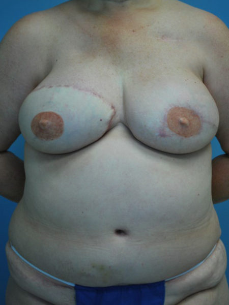 Unilateral Immediate DIEP Flap Patient 15 - After 