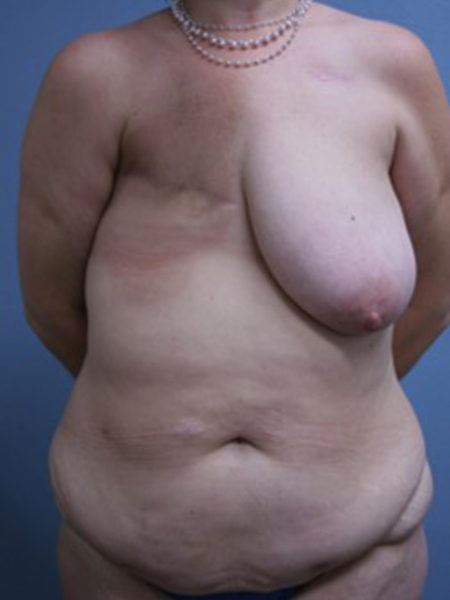 Unilateral Immediate DIEP Flap Patient 15 - Before 