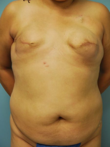 Bilateral Delayed Diep Flap Patient 17 - Before 