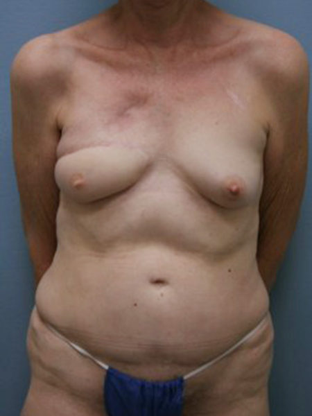 Unilateral Delayed Diep Flap Patient 19 - After 