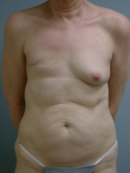 Unilateral Delayed Diep Flap Patient 19 - Before 