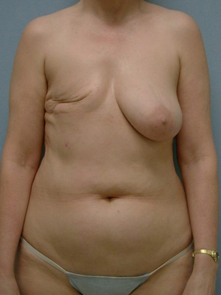 Unilateral Delayed Diep Flap Patient 20 - Before 