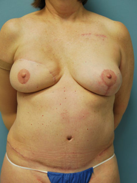 Unilateral Delayed Diep Flap Patient 22 - After 