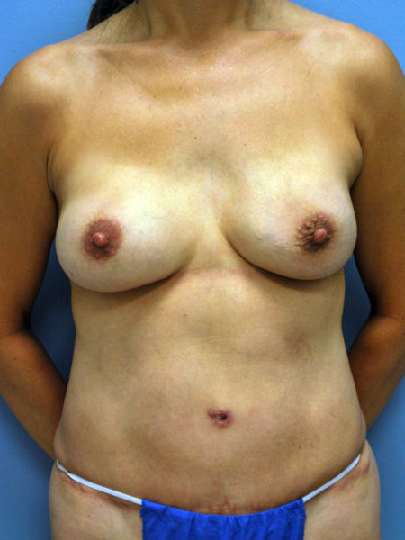 Diep Flap Patient 04 - After 