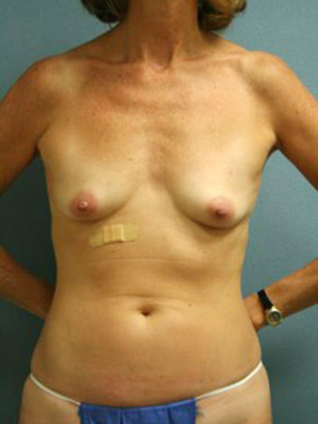 Diep Flap Patient 10 - Before 