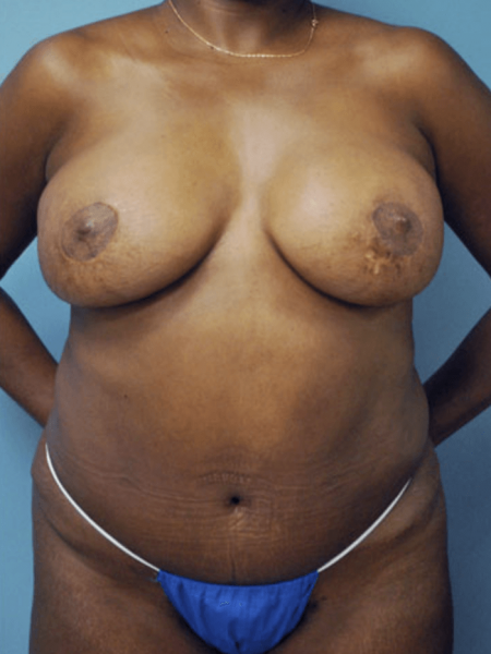 Diep Flap Patient 28 - After 