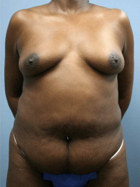 Diep Flap Patient 28 - Before 