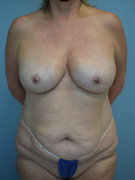 Direct to Implant Patient 42 - After 