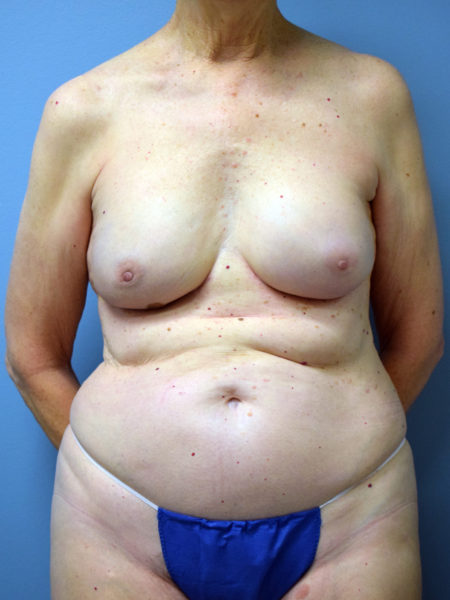 Direct to Implant Reconstruction Patient 16 - After 