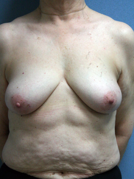 Implant Reconstruction Patient 13 - Before 
