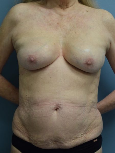 Breast Augmentation Revision Patient 02 - After 
