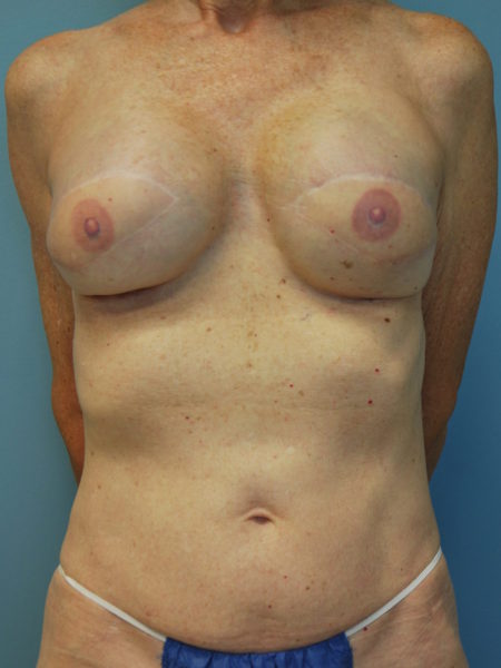 Latissimus Flap Patient 04 - After 
