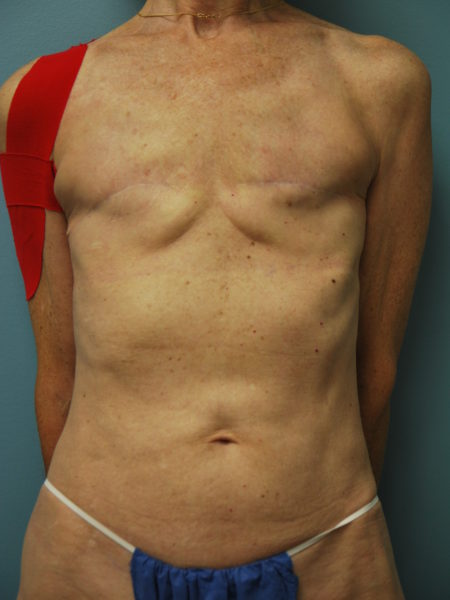 Latissimus Flap Patient 04 - Before 