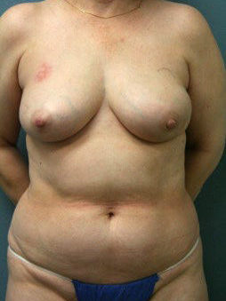 Diep Flap Patient 27 - Before 