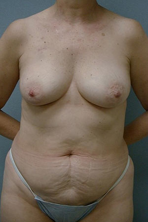 Unilateral Immediate DIEP Flap Patient 16 - Before 